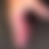 Hand-Fuß-Mund-Krankheit:&nbsp;seit etwa 1 Woche, &nbsp;schmerzhafte, Bläschen, Blasen&nbsp; und P...