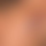 Sarkoidose knotige Form: mehrere, seit etwa 2Jahren bestehende, bisher kontinuierlich gewachsene,...