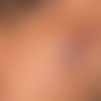 Sarcoidosis nodular form: several, since about 2 years existing, so far continuously grown, sympt...