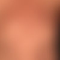 Generalized cGVHD: generalized, lichenoid, only moderately itchy, exanthema with hyperpigmentatio...