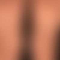 Generalisierte cGVHD: generalisiertes, lichenoides, nur mäßig juckendes,&nbsp;Exanthem&nbsp;mit H...
