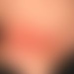 drug reaction fixe: red plaques, existing for several days, moderately sharply defined, little it...