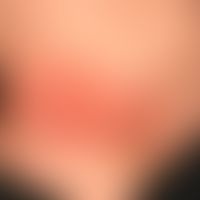 drug reaction fixe: red plaques, existing for several days, moderately sharply defined, little it...