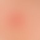 Basal cell carcinoma nodular:slowly growing, smooth surface, somewhat reddish, symptomless, firm ...