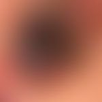 Basalzellkarzinom pigmentiertes: langsam wachsender, zentral ulzerierter, völlig symptomloser Kno...