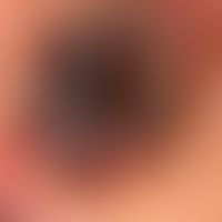basal cell carcinoma pigmented: slowly growing, centrally ulcerated, completely asymptomatic nodu...