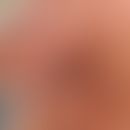Basalzellkarzinom pigmentiertes: langsam wachsender, zentral ulzerierter, völlig symptomloser Kno...