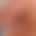 Basalzellkarzinom pigmentiertes: langsam wachsender, zentral ulzerierter, völlig symptomloser Kno...