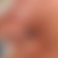 Basal cell carcinoma pigmented: slowly growing, centrally ulcerated, completely asymptomatic nodu...