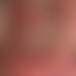 Zoster ophthalmicus: schwer verlaufender Zoster mt tiefreichenden Ulzera, seit etwa 1 Woche beste...