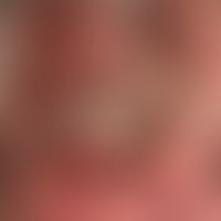 Zoster ophthalmicus: schwer verlaufender Zoster mt tiefreichenden Ulzera, seit etwa 1 Woche beste...