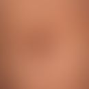 Granuloma anulare erythematous type: little indurated, non-symptomatic reddish-brown plaques with...