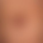 Granuloma anulare erythematöser Typ:&nbsp; wenig indurierte,&nbsp; nicht symptomatische ,rot-brau...