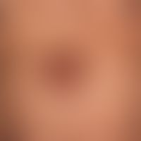 Granuloma anulare erythematöser Typ:&nbsp; wenig indurierte,&nbsp; nicht symptomatische ,rot-brau...
