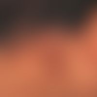 Granulom aktinisches:&nbsp; flächenhafte wenig infiltrierte,&nbsp; nicht symptomatische, konfluie...