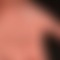 Aquagene palmoplantar keratoderma: normal structure of the palm, no evidence of cornification dis...