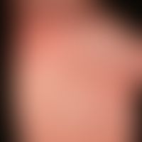 Aquagene palmoplantar keratoderma: Condition after contact with water; extensive white coloration...