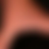 Aquagene palmoplantar keratoderma: condition after contact with water; white coloration of finger...