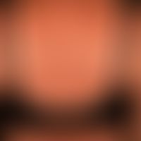 Melanozyt:&nbsp; normale (physiologische) Bräung der Haut durch UV-Strahlen.
