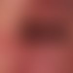 Acute erysipelas with fever (chills), leukocytosis, ASL and CRP elevation, regional lymph node sw...