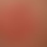 Erythema: extensive, itchy, moderately sharply defined redness
