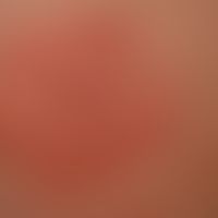 Erythema: extensive, itchy, moderately sharply defined redness

