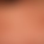 Granuloma actinic: multiple, anular or homogeneously roundish, brown surface smooth plaques: Ceie...
