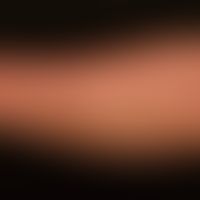 Granuloma anulare disseminatum: non-painful, non-itching, disseminated, large-area (confluent) pl...