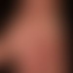 Granuloma anulare disseminatum: non-painful, non-pruritic, disseminated, large-area (confluent) p...