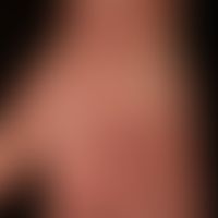 Granuloma anulare disseminatum: non-painful, non-pruritic, disseminated, large-area (confluent) p...