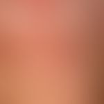 Granuloma anulare disseminatum:non-painful, non-itching, disseminated, large-area plaques that ap...