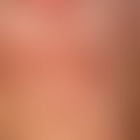 Granuloma anulare disseminatum:non-painful, non-itching, disseminated, large-area plaques that ap...
