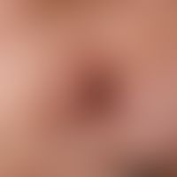 Nodules red, fast growing: few weeks old, symptomless nodule with central brown-black horn plug D...