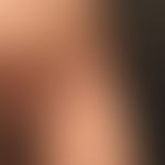 Epidermolysis bullosa junctionalis, non-Herlitz. 25Jahre alter Patient mit generalisiertem Krankh...