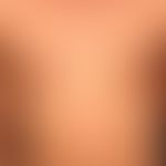 Epidermolysis bullosa junctionalis, non-Herlitz.&nbsp;25&nbsp;Jahre alter&nbsp; Mann mit generali...