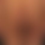 Epidermolysis bullosa junctionalis, non-Herlitz. 25Jahre alter Patient mit generalisiertem Krankh...