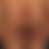 Epidermolysis bullosa junctionalis, non-Herlitz. 25-year-old patient with generalized clinical pi...
