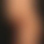 Epidermolysis bullosa junctionalis, non-Herlitz. 25Jahre alter Patient mit generalisiertem Krankh...