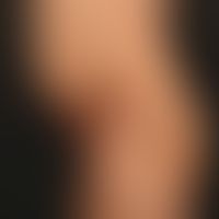 Epidermolysis bullosa junctionalis, non-Herlitz. 25-year-old patient with generalized clinical pi...