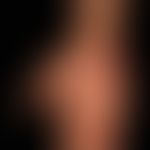 Epidermolysis bullosa junctionalis generalisierte intermediäre (non-Herlitz): Handfläche mit geri...