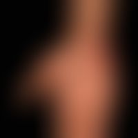 Epidermolysis bullosa junctionalis generalized intermediate (non-Herlitz): palm with minor skin c...