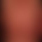 Pityriasis rubra pilaris (adulter Typ):&nbsp;seit Jahren chronisch-rezidivierender Verlauf mit Ph...