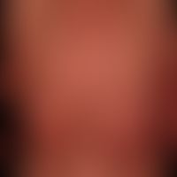 Pityriasis rubra pilaris (adulter Typ):&nbsp;seit Jahren chronisch-rezidivierender Verlauf mit Ph...
