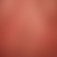 Pityriasis rubra pilaris (adulter Typ):&nbsp;seit Jahren chronisch-rezidivierender Verlauf mit Ph...