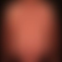 Pityriasis rubra pilaris (adulter Typ):&nbsp;seit Jahren chronisch-rezidivierender Verlauf mit Ph...
