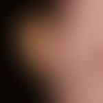 Nodule: Monstrous node on the left nostril in an 85-year-old female patient; histological evidenc...