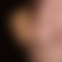 Karzinom kutanes:&nbsp;Monströser, schmerzloser Knoten an dem&nbsp;linken Nasenflügel.&nbsp; 85 J...