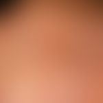 Karzinom kutanes: Zustand nach Operation mit lappenplastischer Versorgung. Seit einigen Wochen Au...