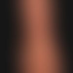 Kaposi's sarcoma epidemic (overview): HIV-associated Kaposi's sarcoma with disseminated, bizarrel...