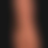 Kaposi's sarcoma epidemic (overview): HIV-associated Kaposi's sarcoma with disseminated, bizarrel...